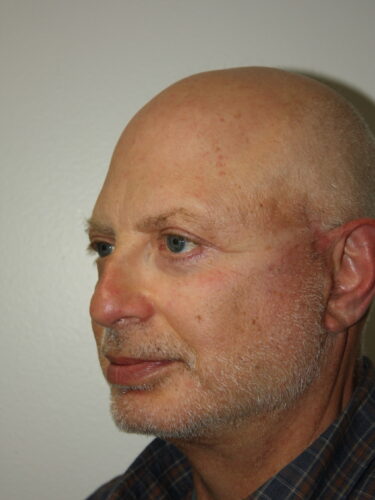Brow Lift Patient 12 and Facelift - After - 2