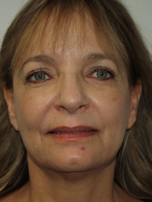 Rhinoplasty Patient 36 - Before - 2