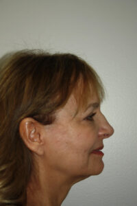 Rhinoplasty Patient 36 - Before - 1 Thumbnail