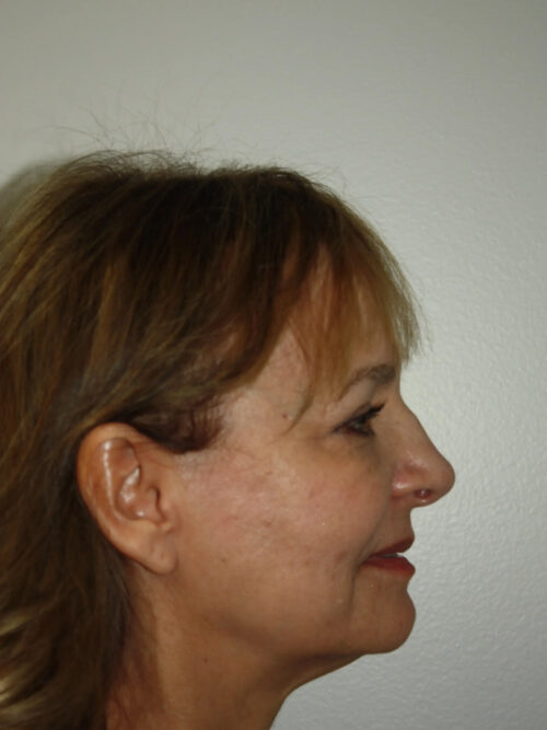 Rhinoplasty Patient 36 - Before - 1