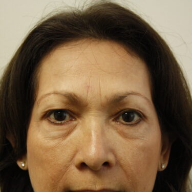 Brow Lift Patient 11 - Before - 1