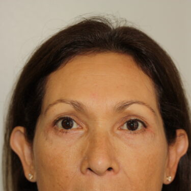 Brow Lift Patient 11 - After - 1