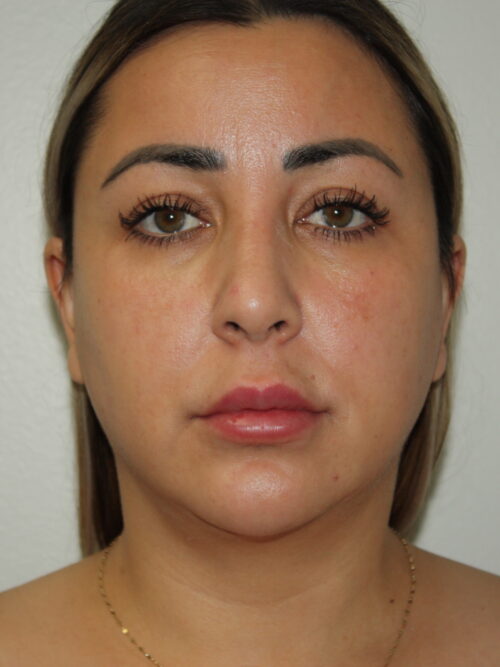 Rhinoplasty Patient 37 and Neck and Chin - After - 2