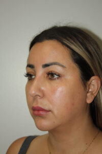 Rhinoplasty Patient 37 and Neck and Chin - After - 3 Thumbnail