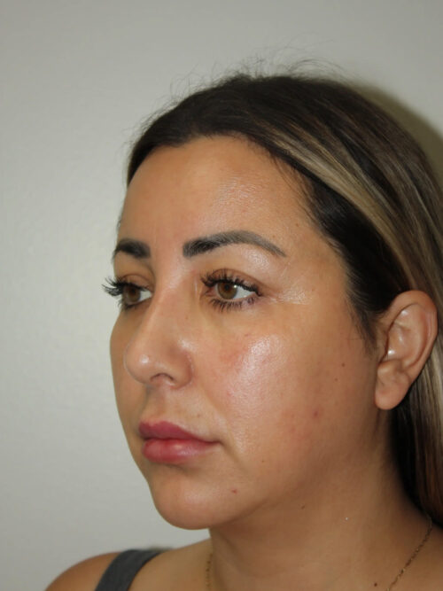 Rhinoplasty Patient 37 and Neck and Chin - After - 3
