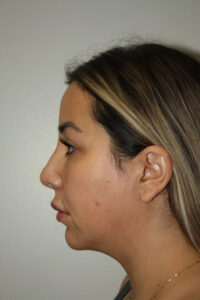 Rhinoplasty Patient 37 and Neck and Chin - After - 1 Thumbnail