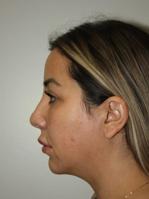 Rhinoplasty Patient 37 and Neck and Chin - After - 1