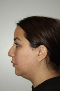 Rhinoplasty Patient 37 and Neck and Chin - Before - 1 Thumbnail