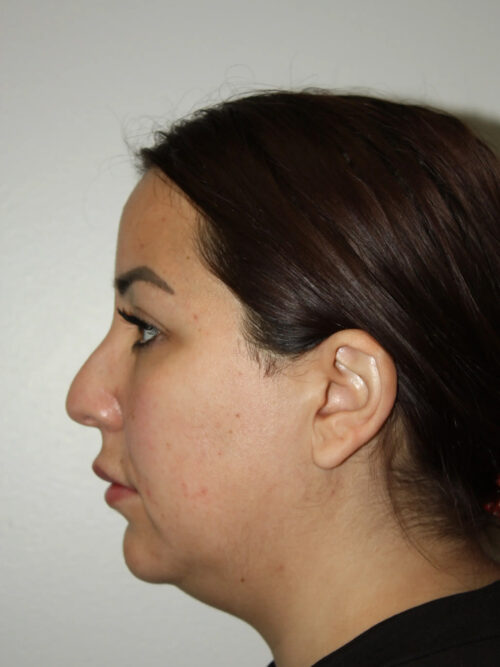 Rhinoplasty Patient 37 and Neck and Chin - Before - 1