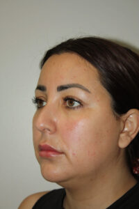 Rhinoplasty Patient 37 and Neck and Chin - Before - 3 Thumbnail