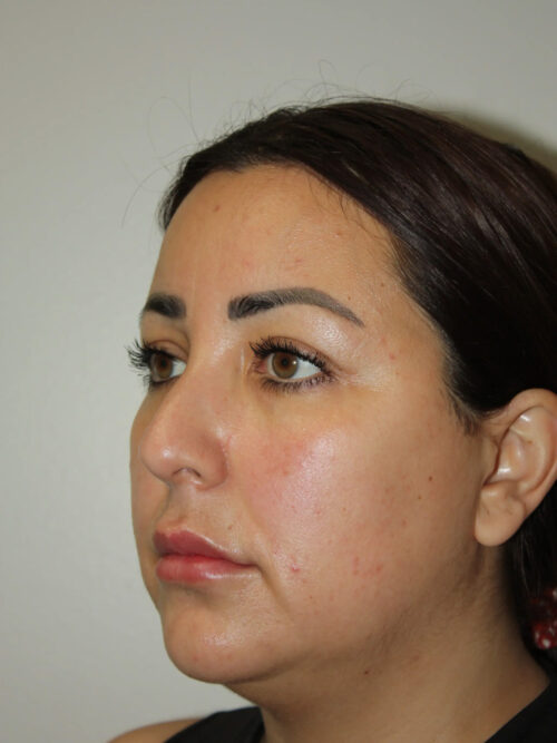 Rhinoplasty Patient 37 and Neck and Chin - Before - 3