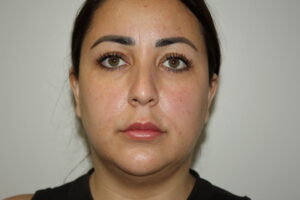 Rhinoplasty Patient 37 and Neck and Chin - Before - 2 Thumbnail