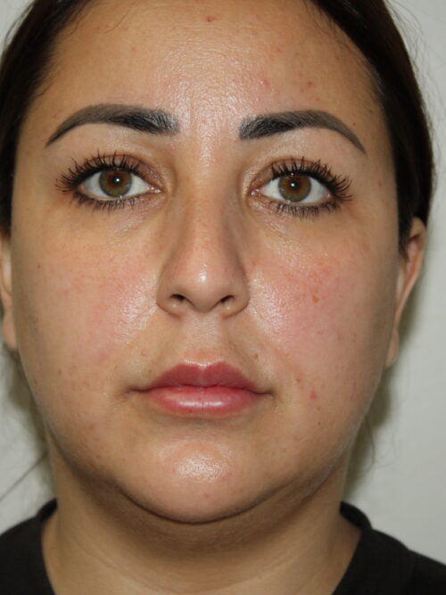 Rhinoplasty Patient 37 and Neck and Chin - Before - 2