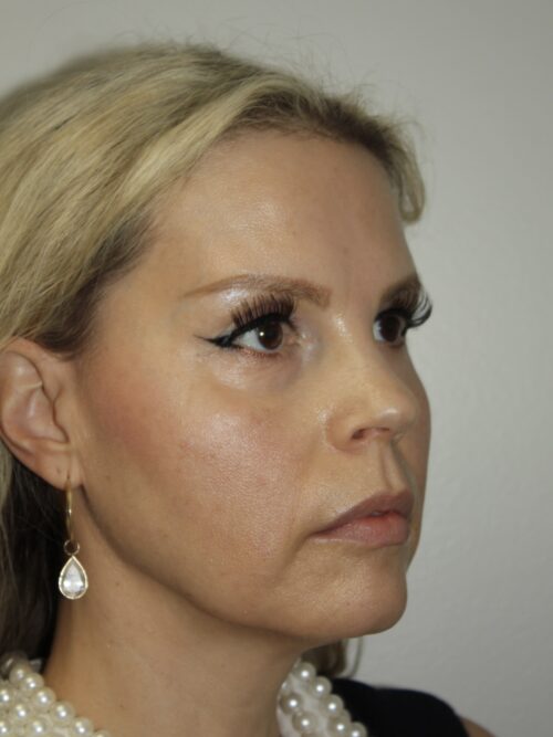 Female Facelift Patient 67 - Before - 1