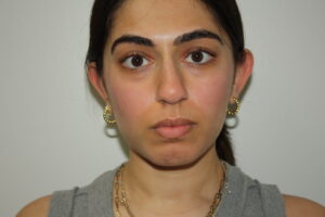 Rhinoplasty Patient 39 and Chin Implant - Before - 3 Thumbnail