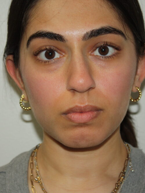 Rhinoplasty Patient 39 and Chin Implant - Before - 3