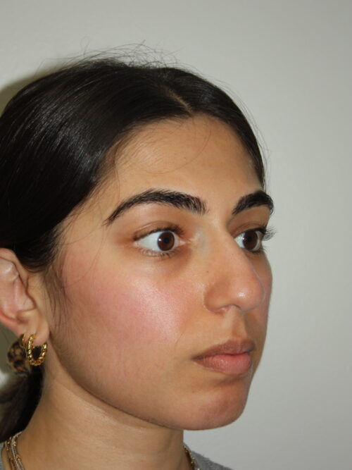 Rhinoplasty Patient 39 and Chin Implant - Before - 2