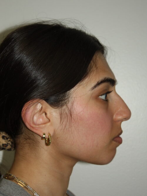 Rhinoplasty Patient 39 and Chin Implant - Before - 1