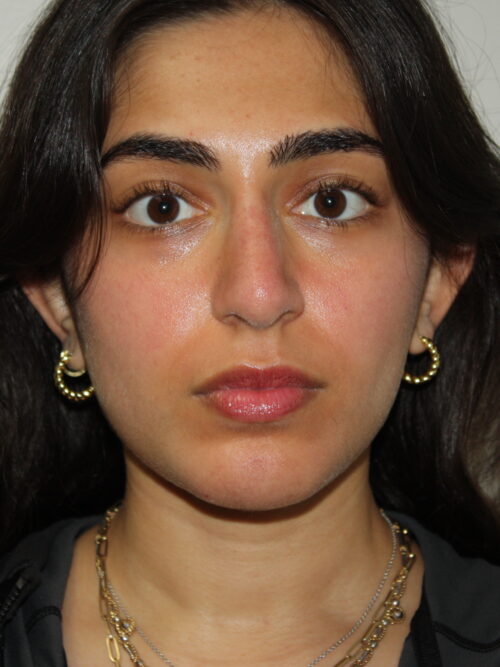 Rhinoplasty Patient 39 and Chin Implant - After - 3