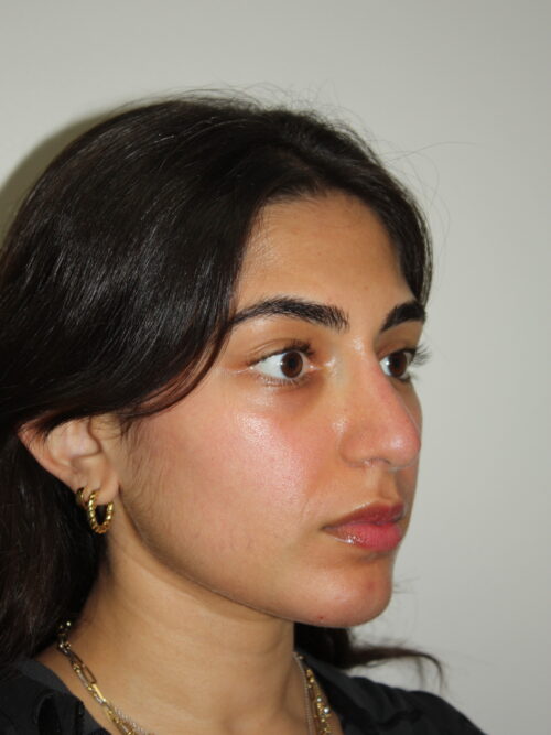 Rhinoplasty Patient 39 and Chin Implant - After - 2