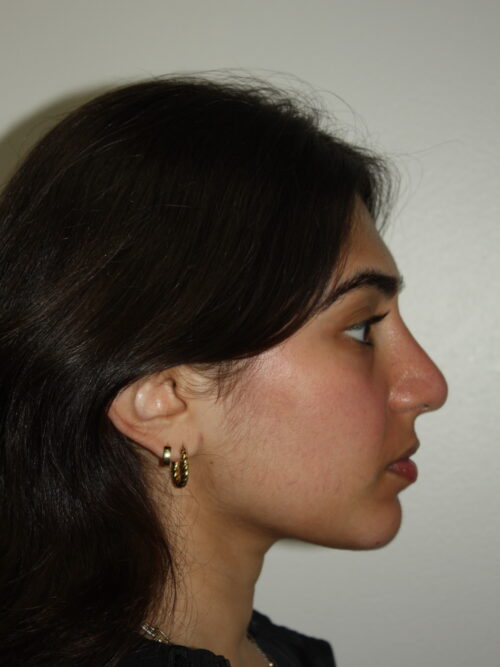 Rhinoplasty Patient 39 and Chin Implant - After - 1