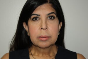 Female Facelift Patient 70 - Before - 2 Thumbnail