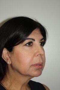 Female Facelift Patient 70 - Before - 1 Thumbnail