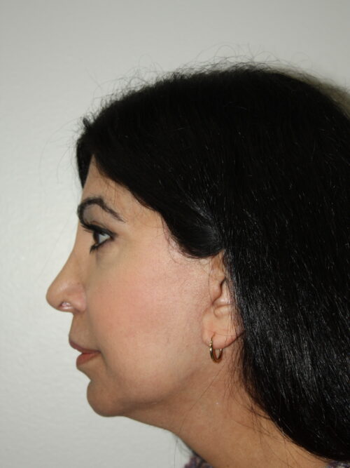 Female Facelift Patient 70 - After - 3