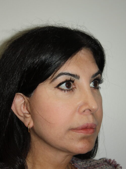Female Facelift Patient 70 - After - 1