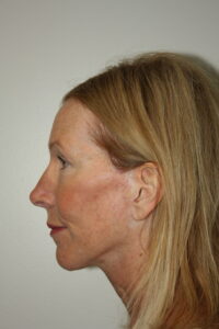 Female Facelift Patient 71 - After - 2 Thumbnail