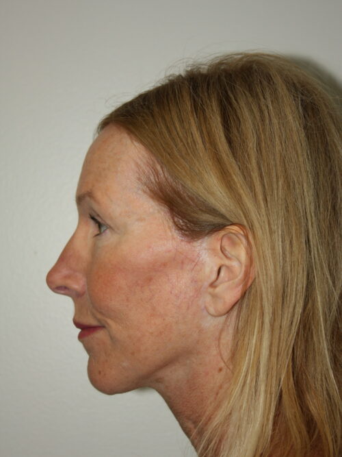 Female Facelift Patient 71 - After - 2