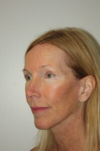Female Facelift Patient 71 - After - 1 Thumbnail