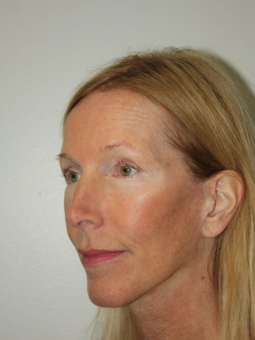 Female Facelift Patient 71 - After - 1
