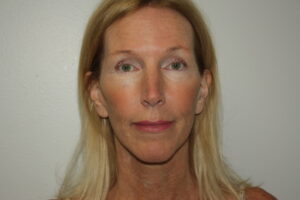 Female Facelift Patient 71 - After - 3 Thumbnail