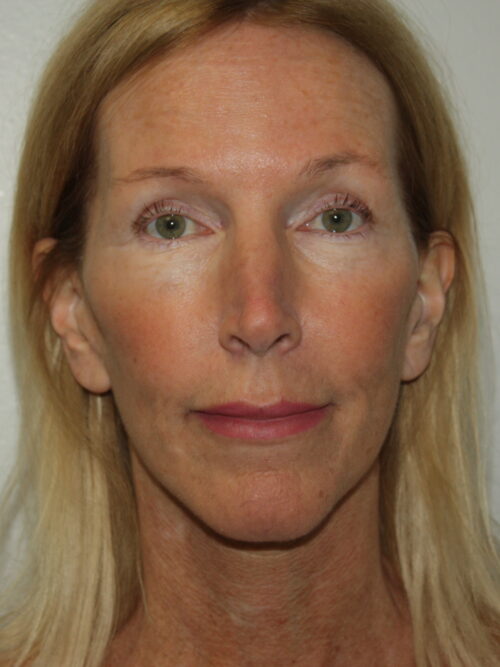 Female Facelift Patient 71 - After - 3