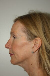 Female Facelift Patient 71 - Before - 2 Thumbnail