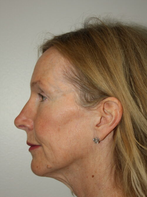 Female Facelift Patient 71 - Before - 2