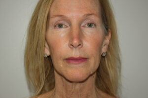 Female Facelift Patient 71 - Before - 3 Thumbnail