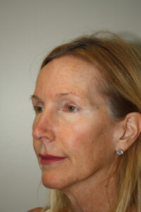 Female Facelift Patient 71 - Before - 1 Thumbnail