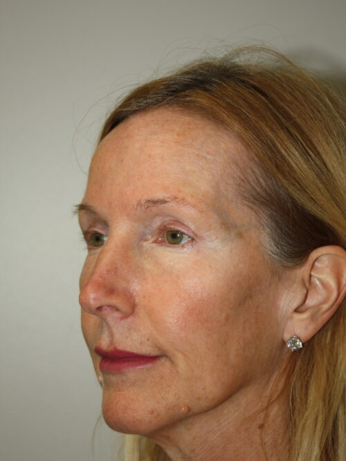 Female Facelift Patient 71 - Before - 1