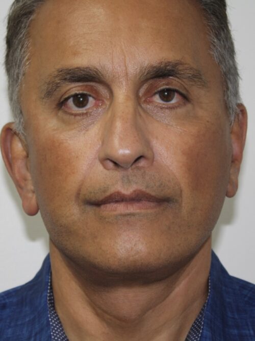 Male Facelift Patient 31 - After - 3
