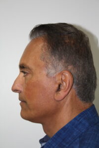 Male Facelift Patient 31 - After - 2 Thumbnail