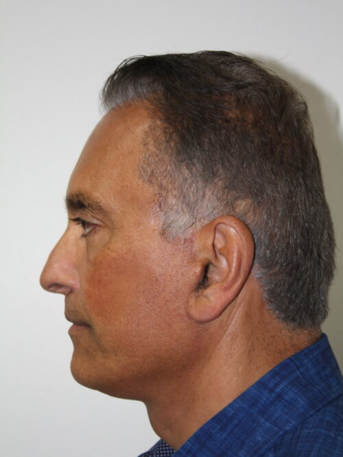 Male Facelift Patient 31 - After - 2