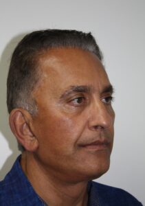 Male Facelift Patient 31 - After - 1 Thumbnail