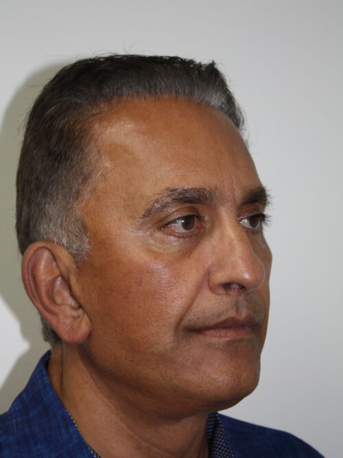 Male Facelift Patient 31 - After - 1