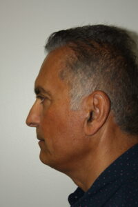 Male Facelift Patient 31 - Before - 2 Thumbnail