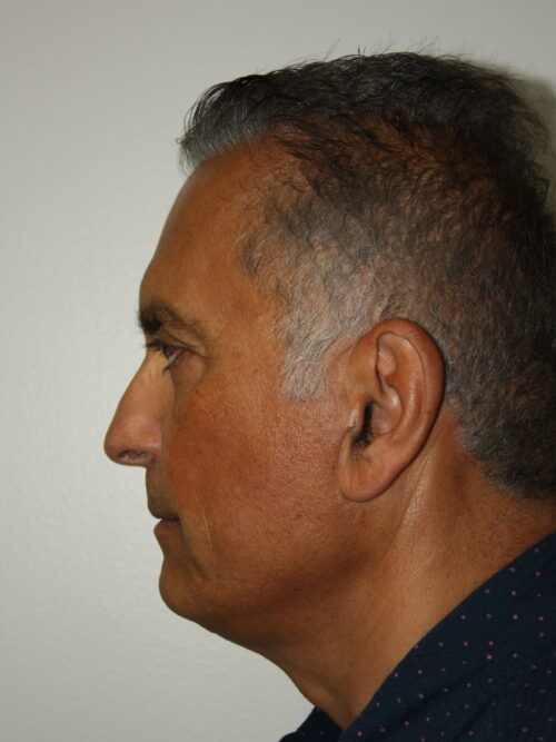 Male Facelift Patient 31 - Before - 2