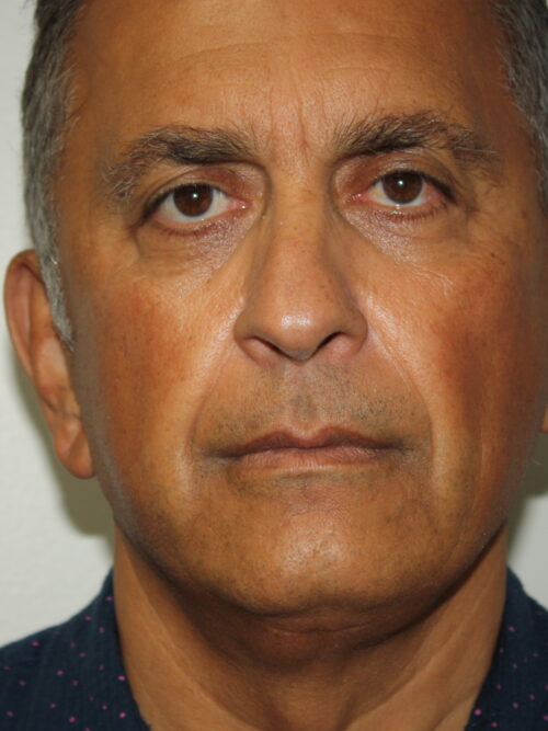 Male Facelift Patient 31 - Before - 3