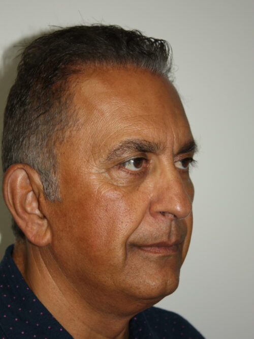 Male Facelift Patient 31 - Before - 1