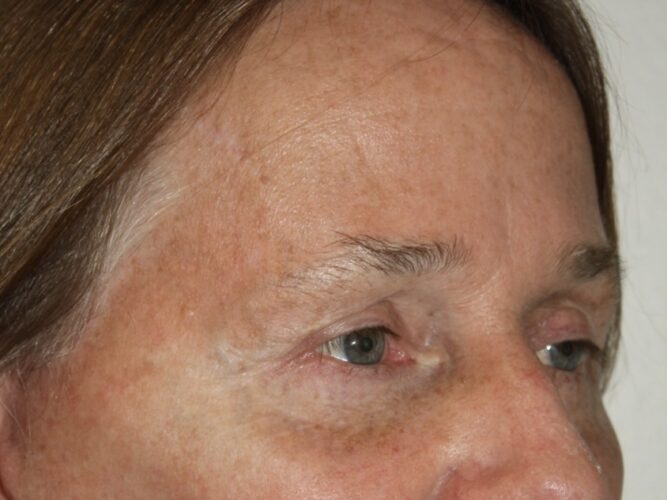 Eyelid Patient 21 - After - 2